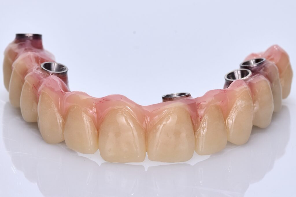 Dental prosthesis with screw anchor, particular upper attachment